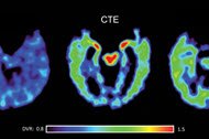 Chronic Traumatic Encephalopathy (CTE)